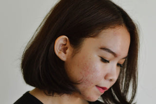 Dry Congested Skin Causes Breakouts