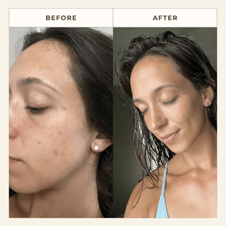 Skin improvement visible.