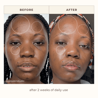 Jennifer NCM skin improvement before & after 2 weeks